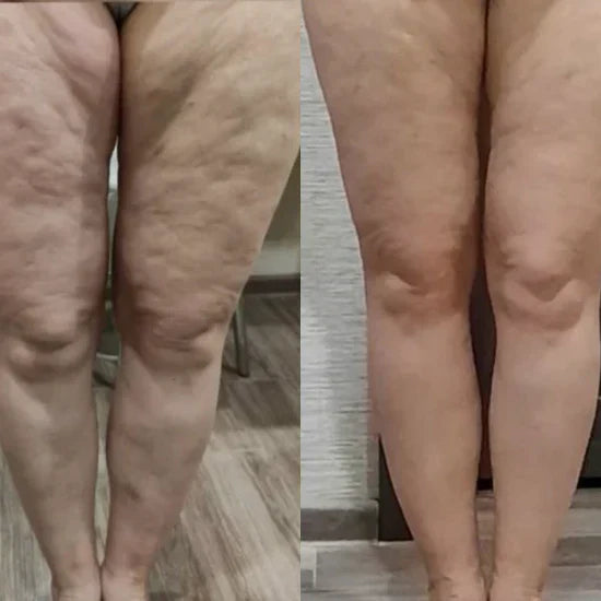 Anti-Cellulite Massager